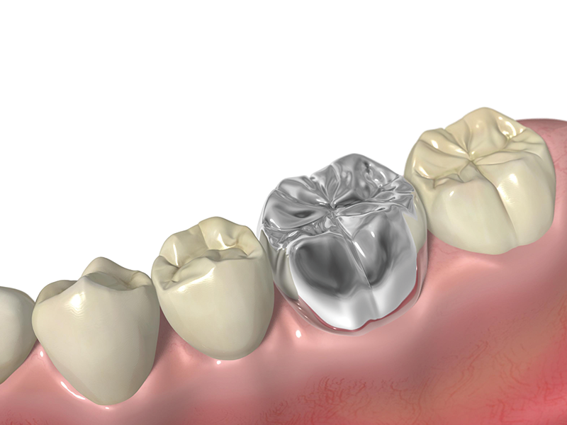 セラミック　クラウン