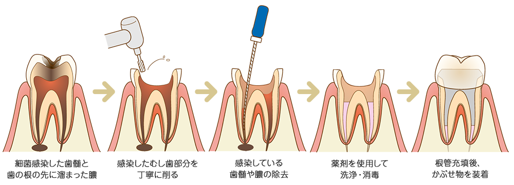 歯の根の治療順序